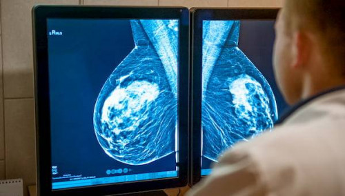 40 yaş üstü kadınlara ücretsiz mamografi taraması